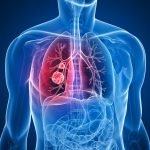 Alerta: el consumo excesivo de vitaminas B6 Y B12 producen cáncer de pulmon