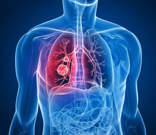 Alerta: el consumo excesivo de vitaminas B6 Y B12 producen cáncer de pulmon